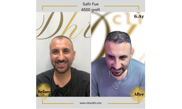 İzmir Saç Ekimi